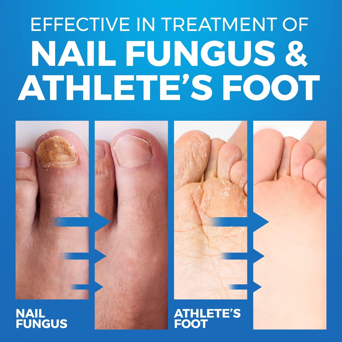 Toenail Fungus Treatment Extra Strength - Advanced Foot & Shoe Deodorizer Spray - XL - Athletes Foot Shoe Spray for Fungal Treatment - 5.07 Fl oz