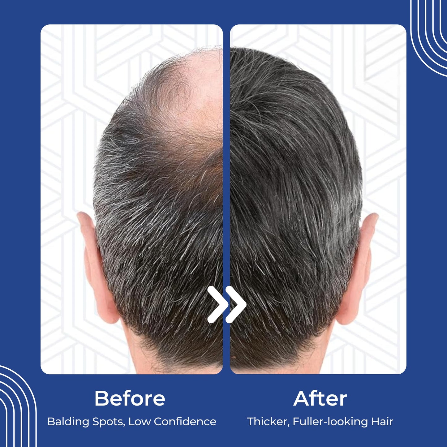 Hair Regen Liquid Minoxidil Men 5% With Hair Derma Roller for Scalp - Advanced Topical Solution for Regrowth - Men's Minoxidil for Growth of Men Hairs Loss 6 Pack as 6 Months Supply Kit