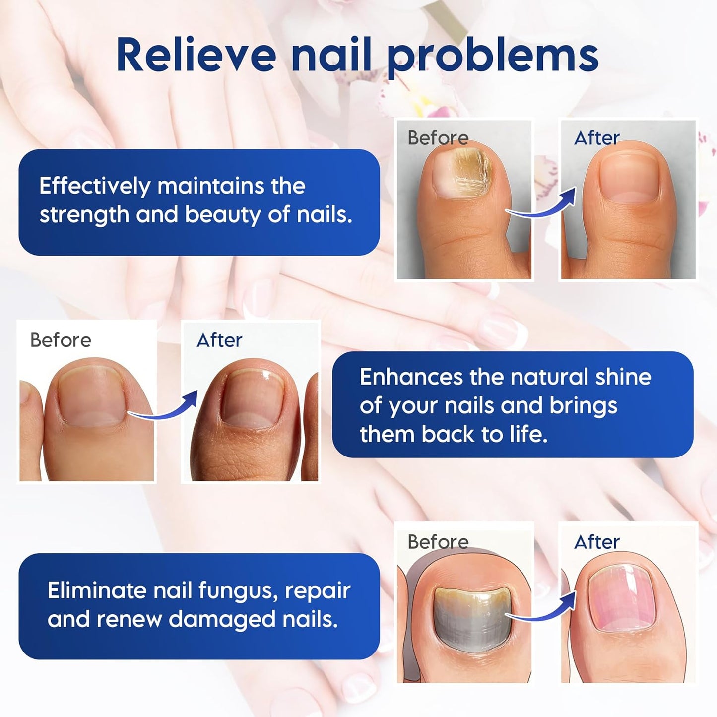 32 Pcs Hydrogel Toenail Treatment Patches - Extra Strength for Ingrown Toenail Care | Overnight Repair