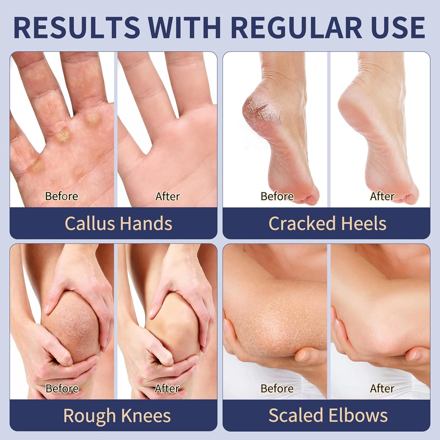 Urea Cream 40% for Feet - Maximum Strength Foot Cream with 2% Salicylic Acid | Intensive Repair for Dry, Cracked Heels