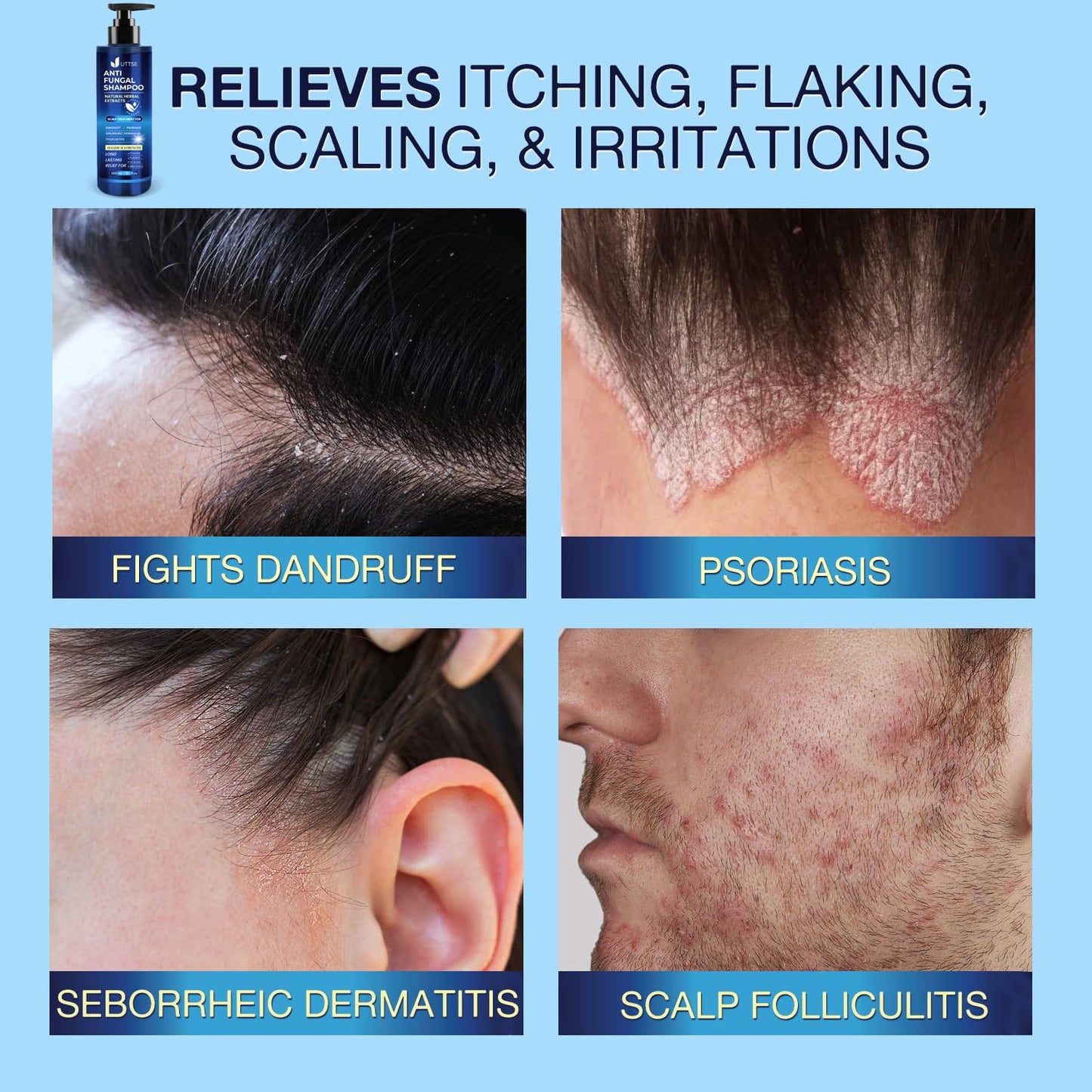 Anti-Fungal Shampoo for Scalp Psoriasis | Dandruff Relief for Folliculitis & Seborrheic Dermatitis - 300 mL / 10.1 fl. oz