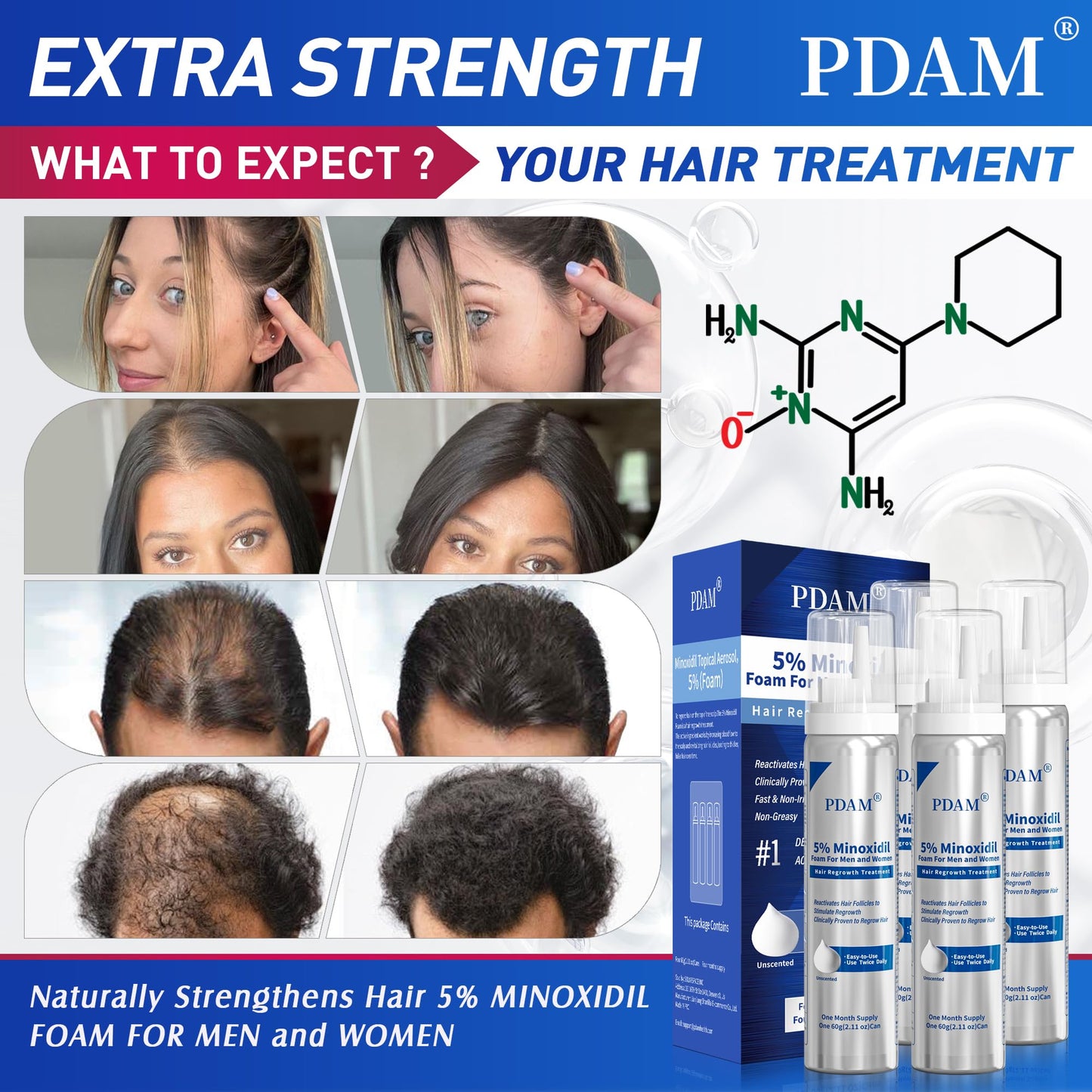 PDAM 5% Minoxidil for Men and Women Foam – Clinically Proven Regrowth for Thinning Hair, Topical Hair Loss Treatment, Extra Strength Foam for Thicker, Fuller Hair, 4-Month Supply (4 x 2.11 oz)