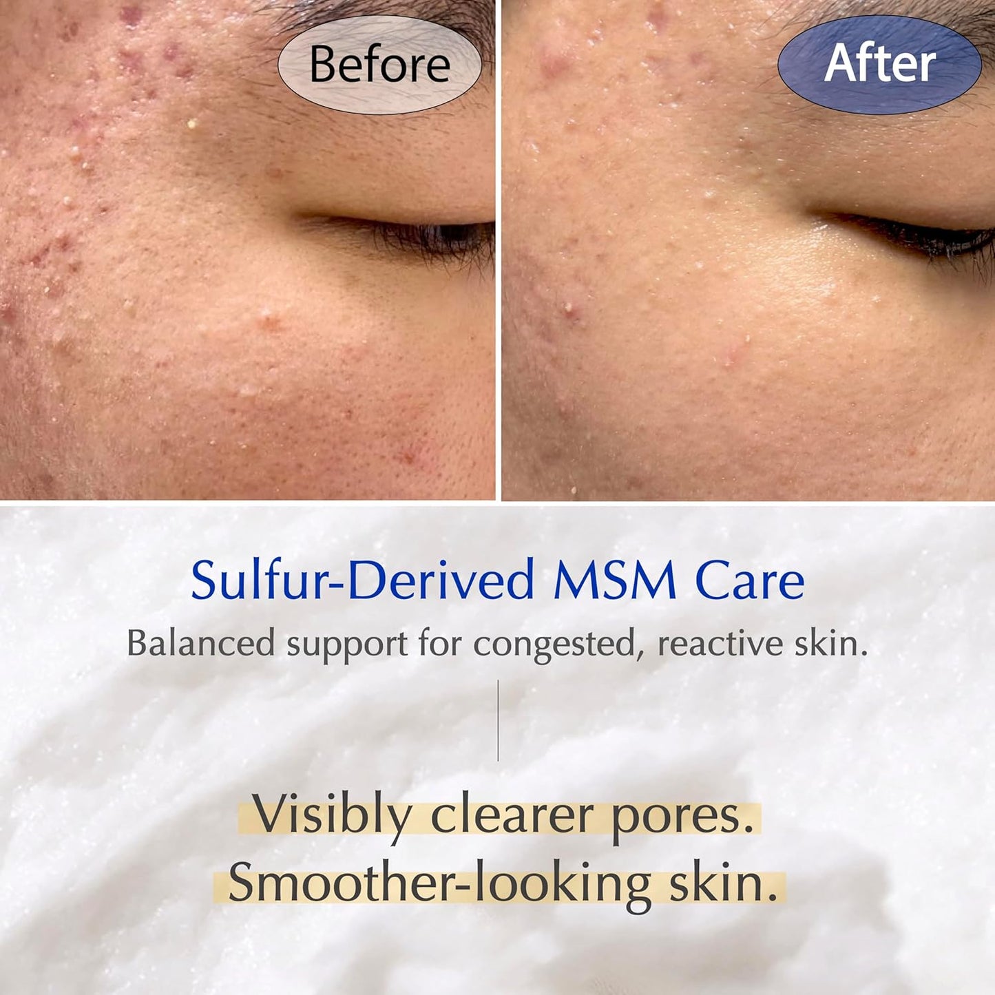 MSM Sulfur Deep Pore Cleanser - Gentle Low pH Face Wash for Sensitive Skin | Pore Reset Formula