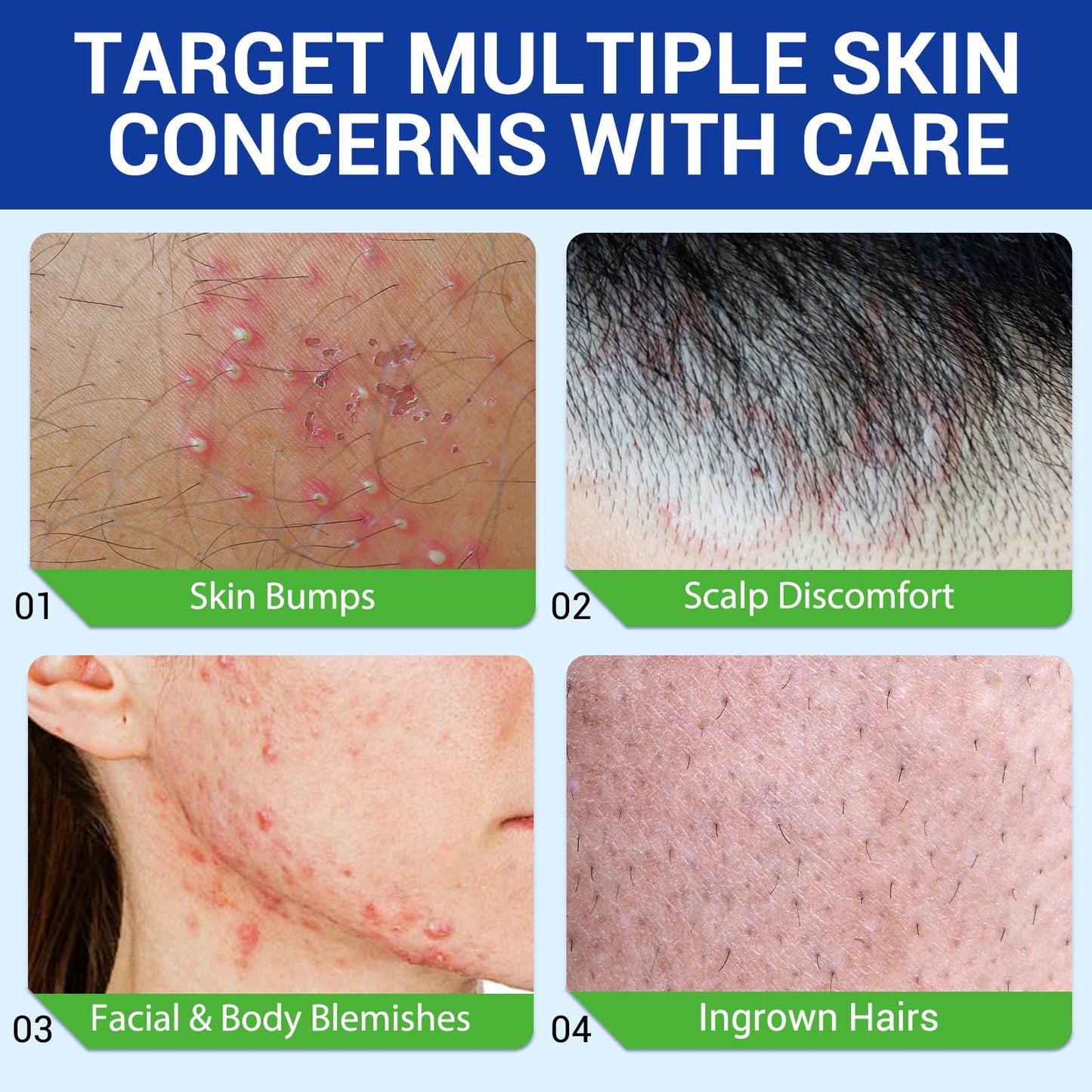 ReliCo Folliculitis Acne Cream, Pores Care & Acne Prone Skin – Scalp Face Body Lotion for Rough Bumps, Clogged Pores & Excess Oil – Gentle Formula with Plant Extracts for Daily Use