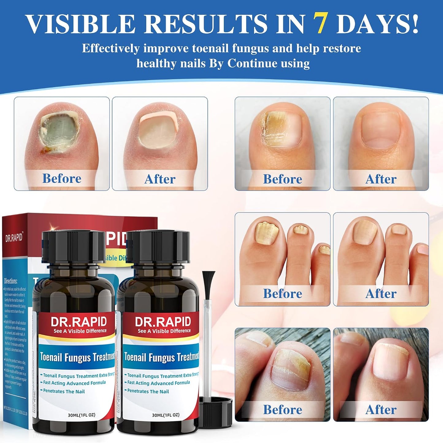 Toenail Fungus Treatment - Extra Strength Antifungal Solution with Tea Tree Oil | Fast-Acting Repair for Damaged Nails - 60ml/2fl oz