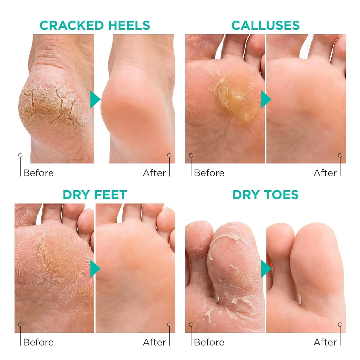 Lavinso Foot Peel Mask - Exfoliating Dry Cracked Feet Treatment | 2 Pack for Soft, Smooth Skin