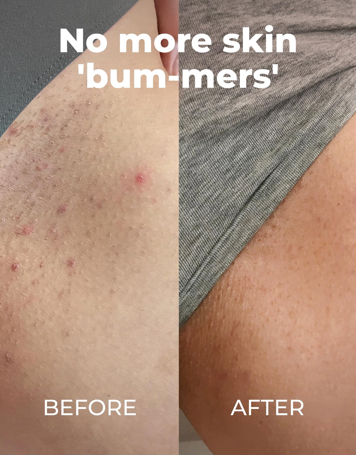 Miami Beach Bum Bum Body Cream - 6.7 oz Bum Lotion Oregano Aloe + Jojoba Daily Moisturizer for Skin Health, Razor Bumps, Keratosis Pilaris, Ingrown Hairs, Sunburns, Blemishes