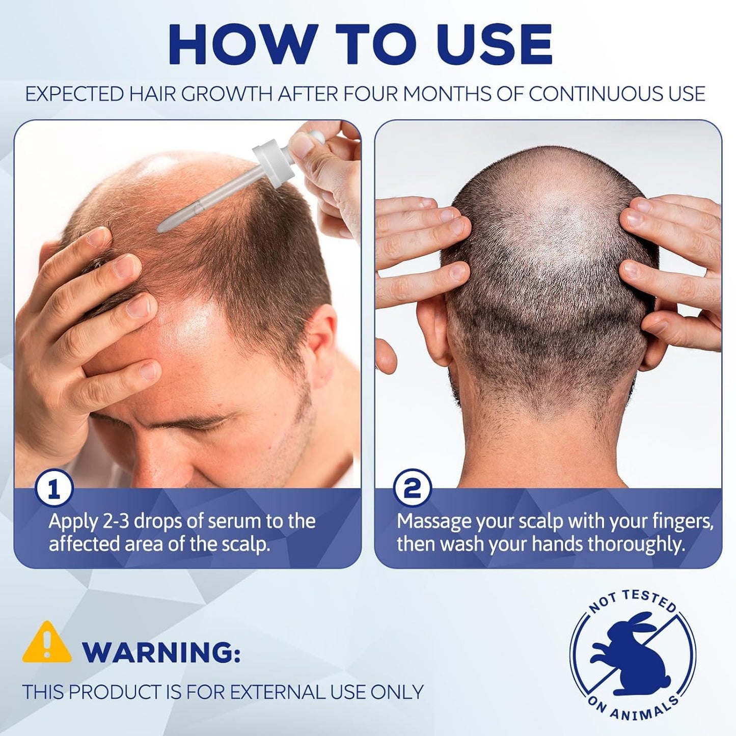 5% Minoxidil for Men and Women, Hair Growth Biotin Serum, Hair Beard Regrowth Treatments, Extra Strength Hair Loss to Regrow Thicker, Topical Solution, 2 Months Supply, Dermatologist Recommended
