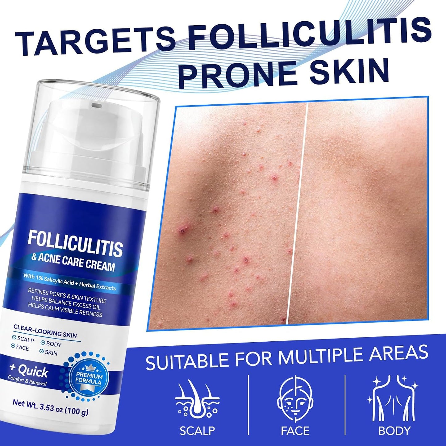 Folliculitis Cream - 1% Salicylic Acid & Herbal Extracts | Pore Refining, Multi-Area Use for Scalp, Face & Body, 100g