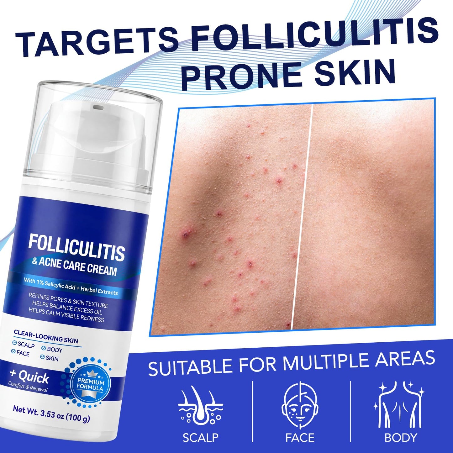 Folliculitis Cream with 1% Salicylic Acid & Herbal Extracts， Pore Refining & Balance Excess Oil, Multi-Area Use for Scalp, Face & Body, 100g