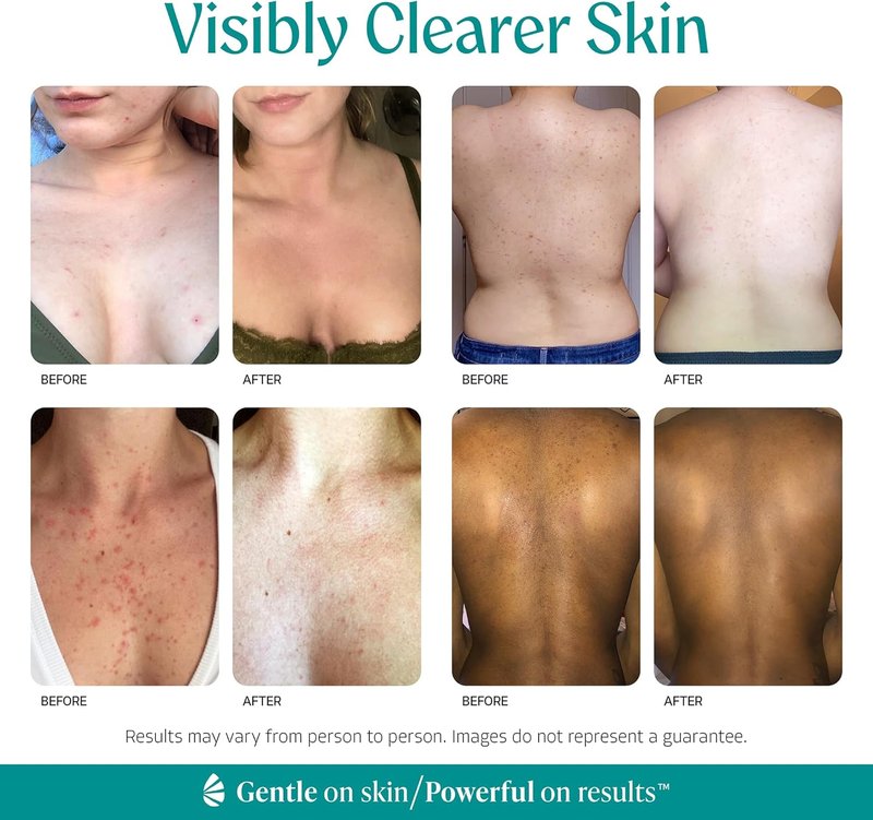 Body Clearing Serum - Level 2 Acne Treatment with Mandelic Acid | 1 Fl Oz for Body, Back, Chest & More