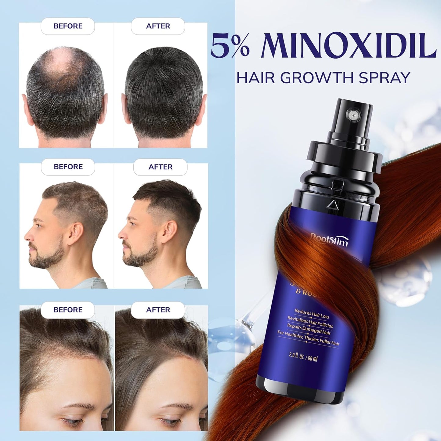 Minoxidil Hair Growth Serum for Men & Women - Extra Strength Treatment with Rosemary | 2-Pack, 4 FL OZ