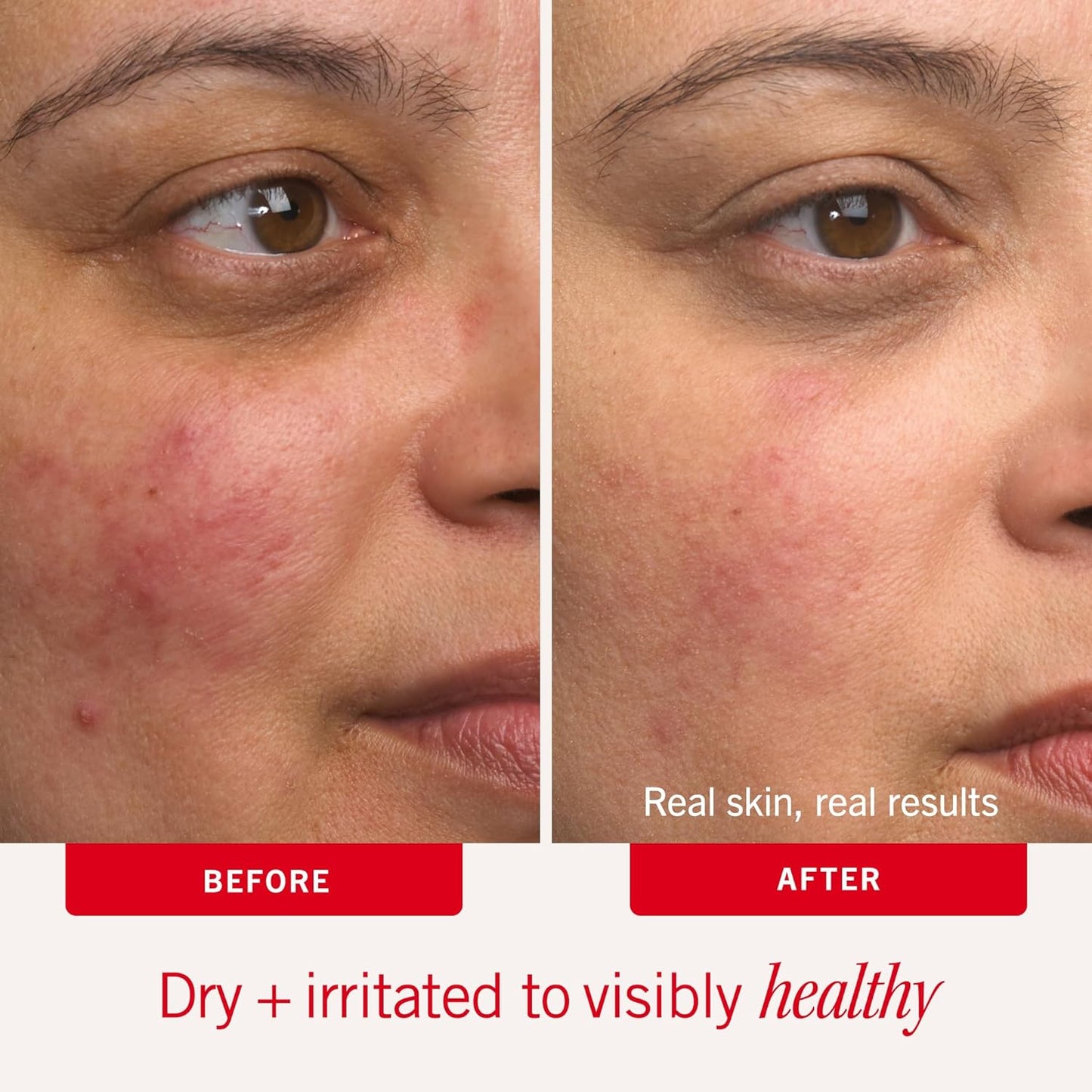 First Aid Beauty Ultra Repair Cream - Intense Hydration Face & Body Moisturizer | Eczema Support, Fragrance-Free