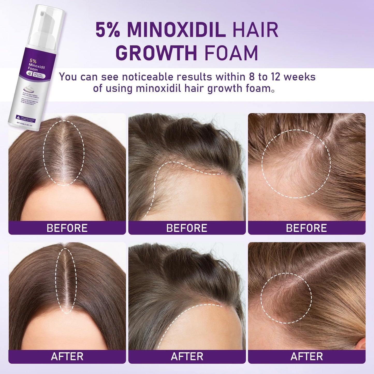 5% Minoxidil Foam for Women Hair Growth Foam Suitable for Hair Thinning Receding Hairline and Hair Loss to Hair Regrowth Get Thicker Fuller Hair 2 Bottles
