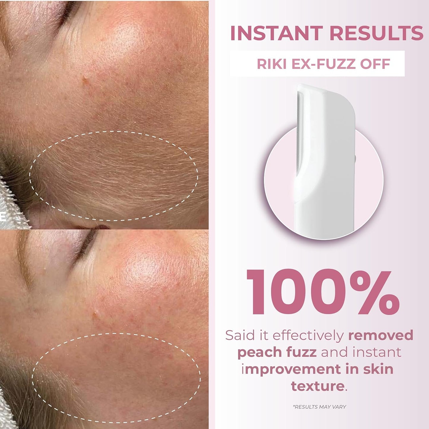 RIKI Dermaplaning Facial Tool - Stainless Steel Razor for Peach Fuzz Removal & Gentle Exfoliation | At-Home Skincare Tool
