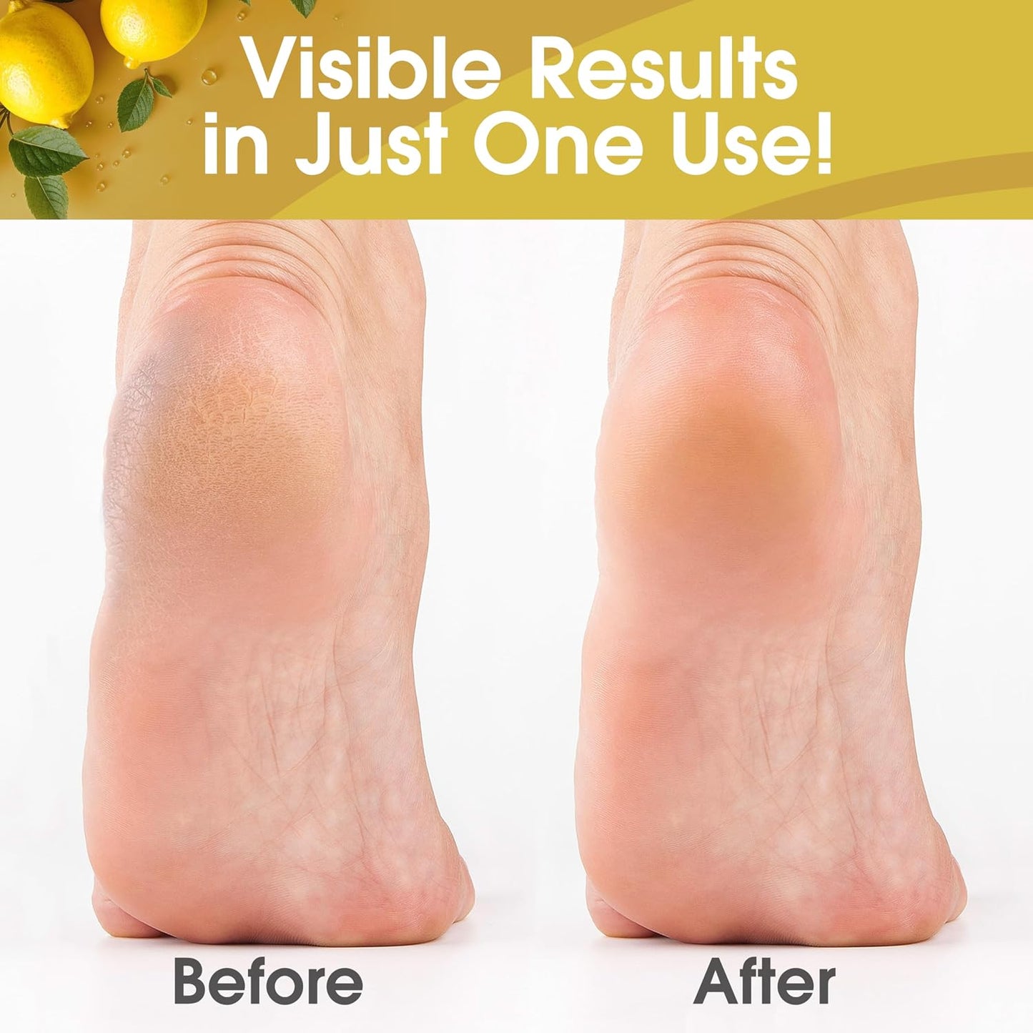 Callus Remover Gel for Feet - Extra Strength 8oz | Professional Pedicure Supplies for Dry Skin & Cracked Heels