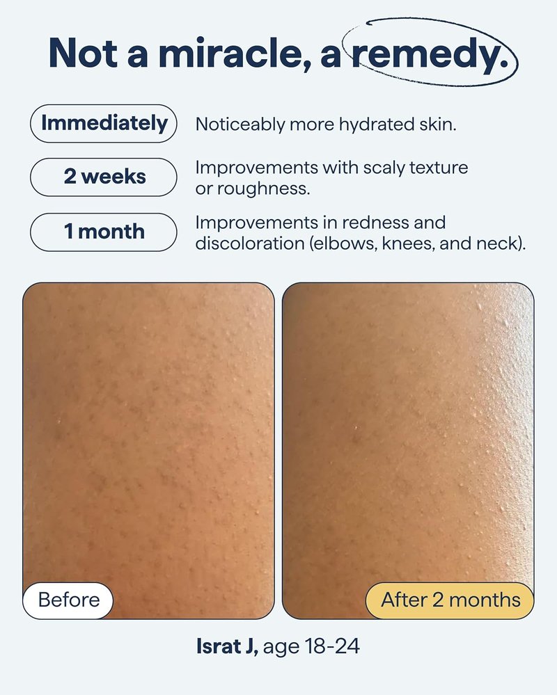 Remedy KP Body Moisturizer - Keratosis Pilaris Treatment with Retinol & Urea | Exfoliating Lotion, 7.7 fl oz