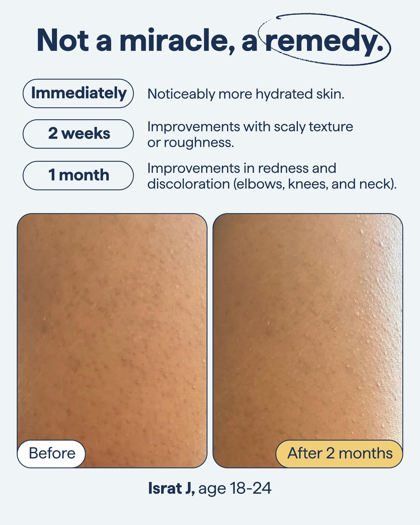 Remedy KP Body Moisturizer | Keratosis Pilaris and Chicken Skin Treatment with Retinol, Urea, Lactic Acid and Ceramides | Exfoliating and Moisturizing Lotion | By Dermatologist Dr. Shah, 7.7 fl oz