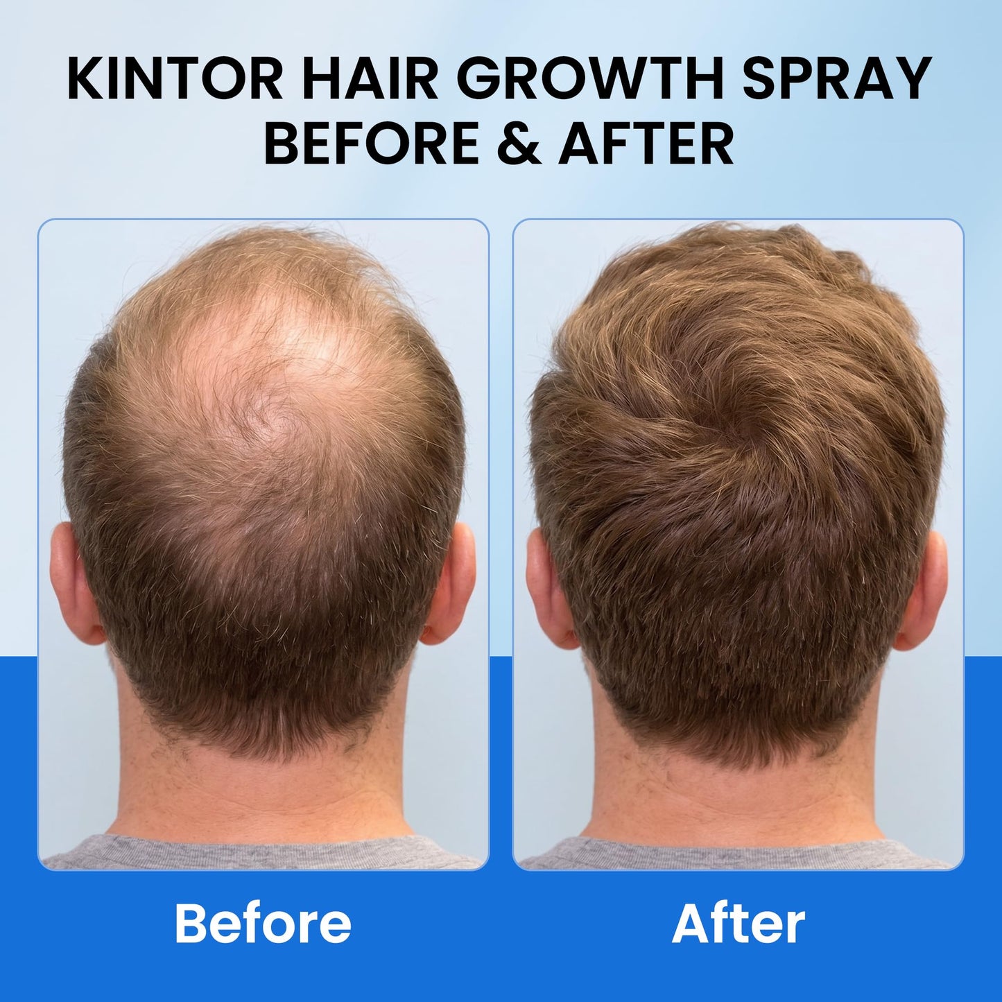 KINTOR KX-826 DHT Blocker for Men & Women Hair Growth,Hair Growth Products Spray 60ml Pro (Green-1PCS)