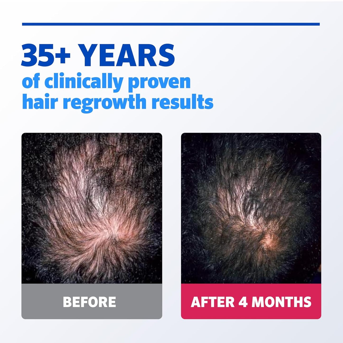 Men's Rogaine Extra Strength Minoxidil 5% Hair Regrowth Solution - Unscented, 2 fl. oz, 1-Month Supply
