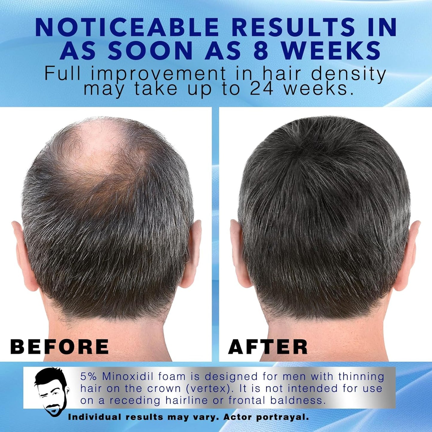 5% Minoxidil Foam for Hair Regrowth | Topical Hair Loss Treatment for Men - 60ml / 2.11oz