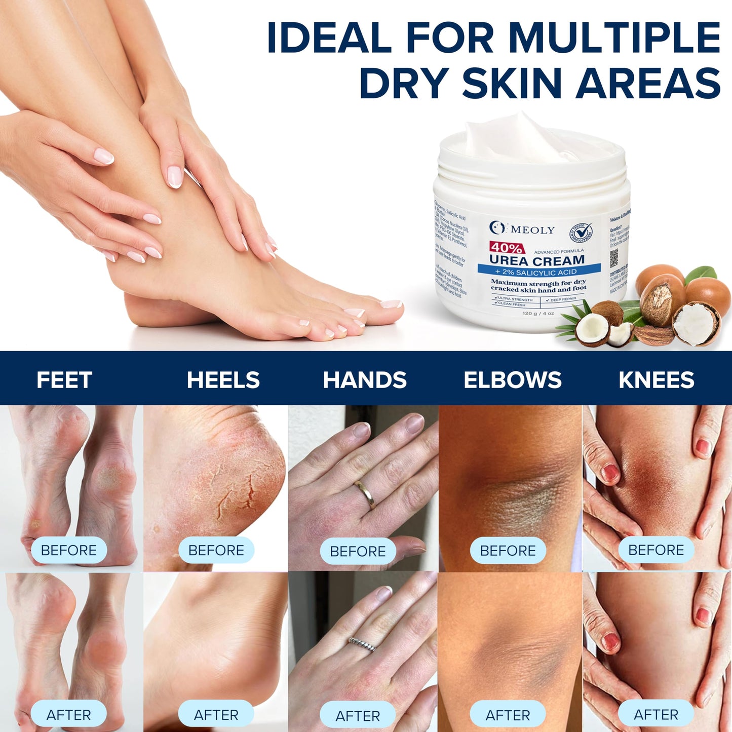 MEOLY 40% Urea Cream for Foot with 2% Salicylic Acid for Dry Cracked Skin Hand and Foot, Maximum Strength, 4 oz