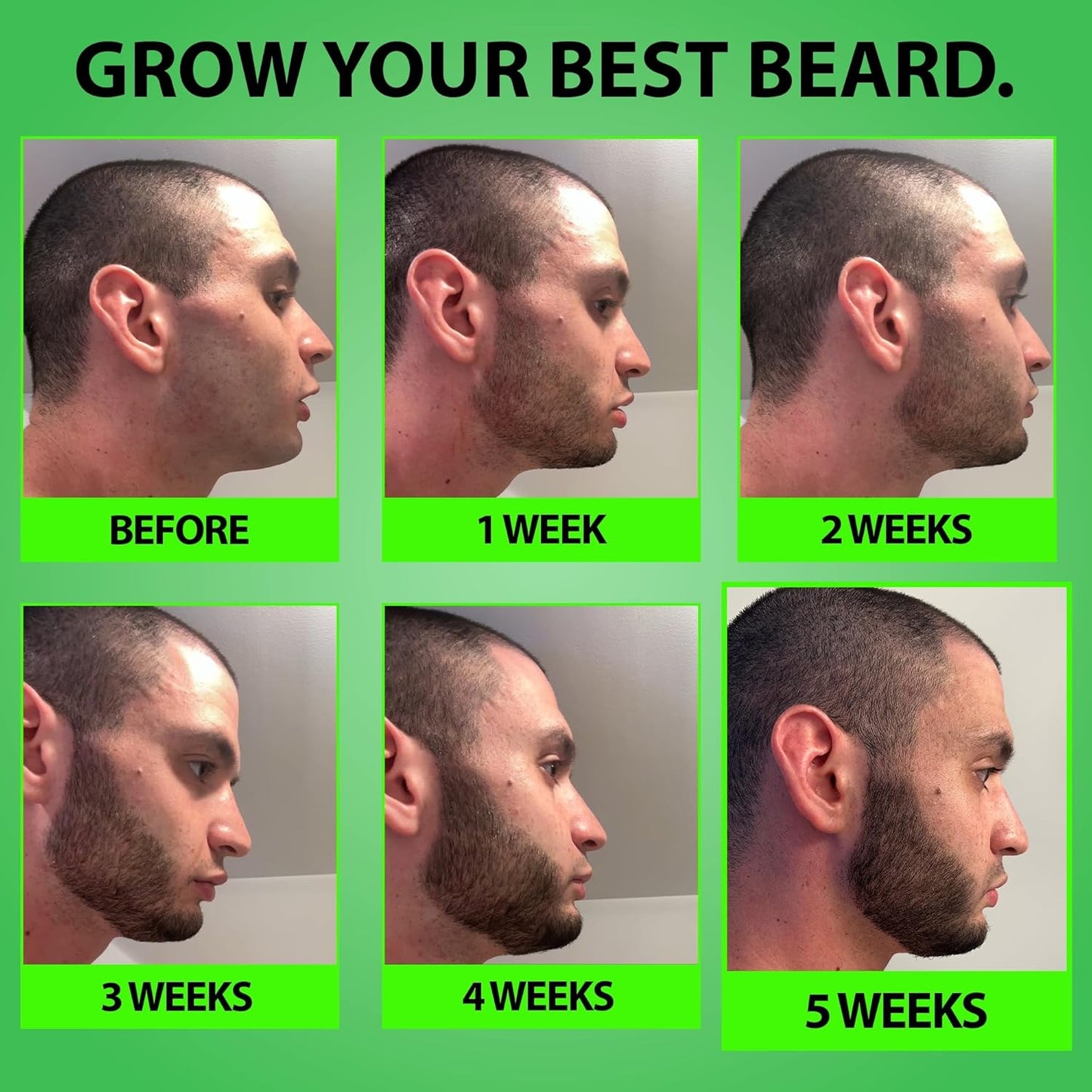 Minoxidil Beard Growth Serum - 5% Formula with 2X Biotin & Rice Water for Thicker Facial Hair | Ideal for Patchy Areas