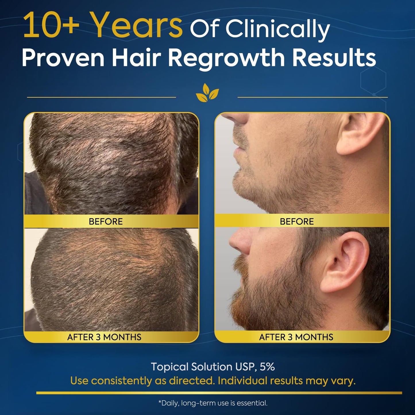 5% Minoxidil Beard Growth Kit For Men: Hair Loss and Hair Regrowth Treatments - Thicker Fuller for Facial & Scalp Hair