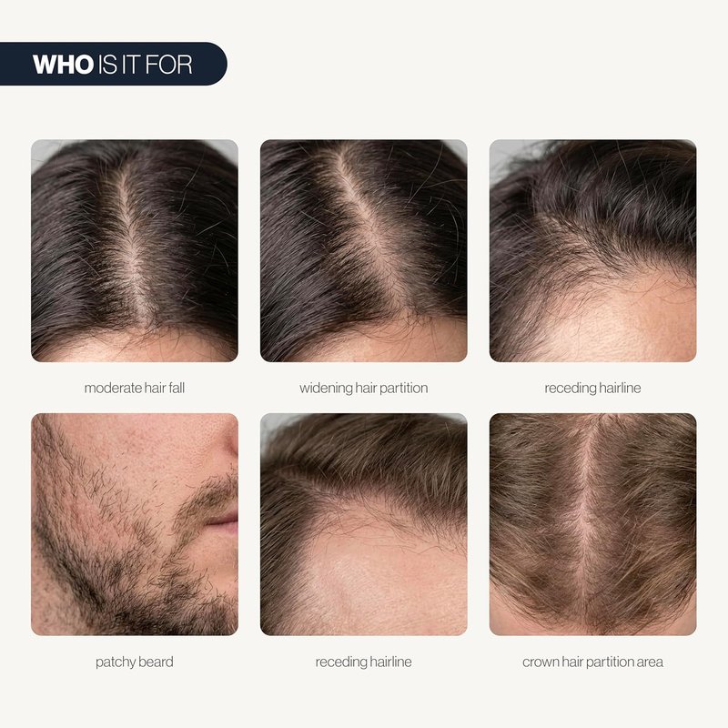 Hair Growth Serum Roll-On - 5% Saw Palmetto & 3% Rosemary Oil | Hair Regrowth for Men & Women - 25ml
