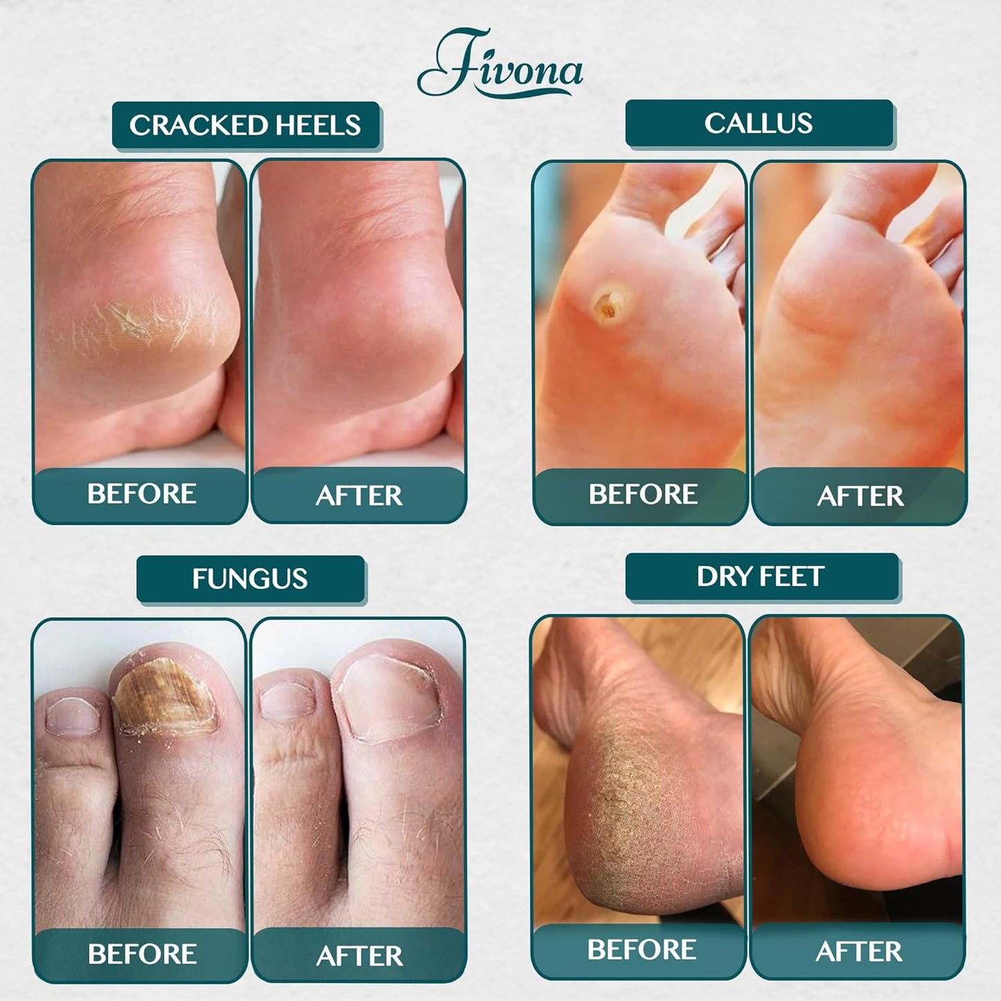 Tea Tree Foot Soak Blend - Epsom Salt with Essential Oils for Healthy Toenails | 14.1 oz, Soothing Relief & Callus Softening