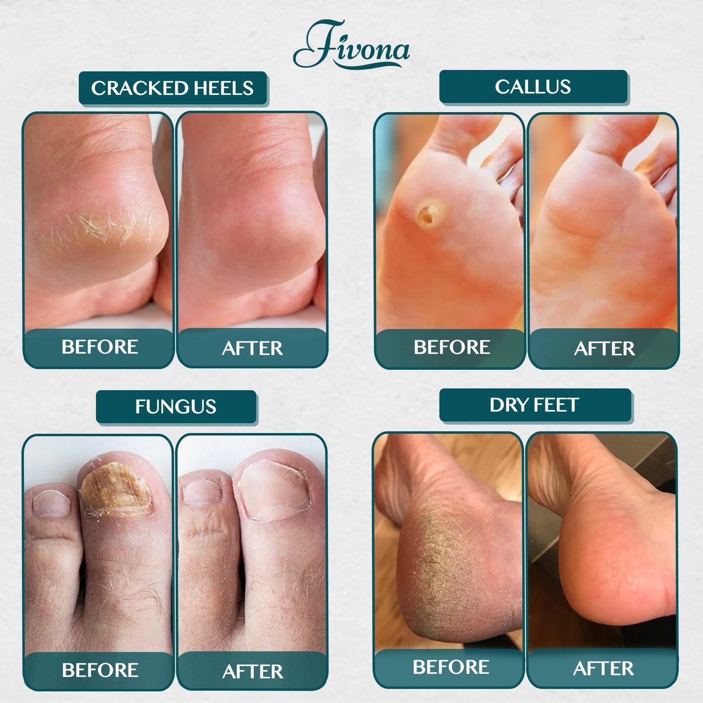 Fivona Tea Tree Foot Soak Blend 14.1 oz - Epsom Salt with Essential Oils for Healthy Toenails, Soothing Relief, Callus Softening - Pedicure Therapy for Soft, Rejuvenated Feet