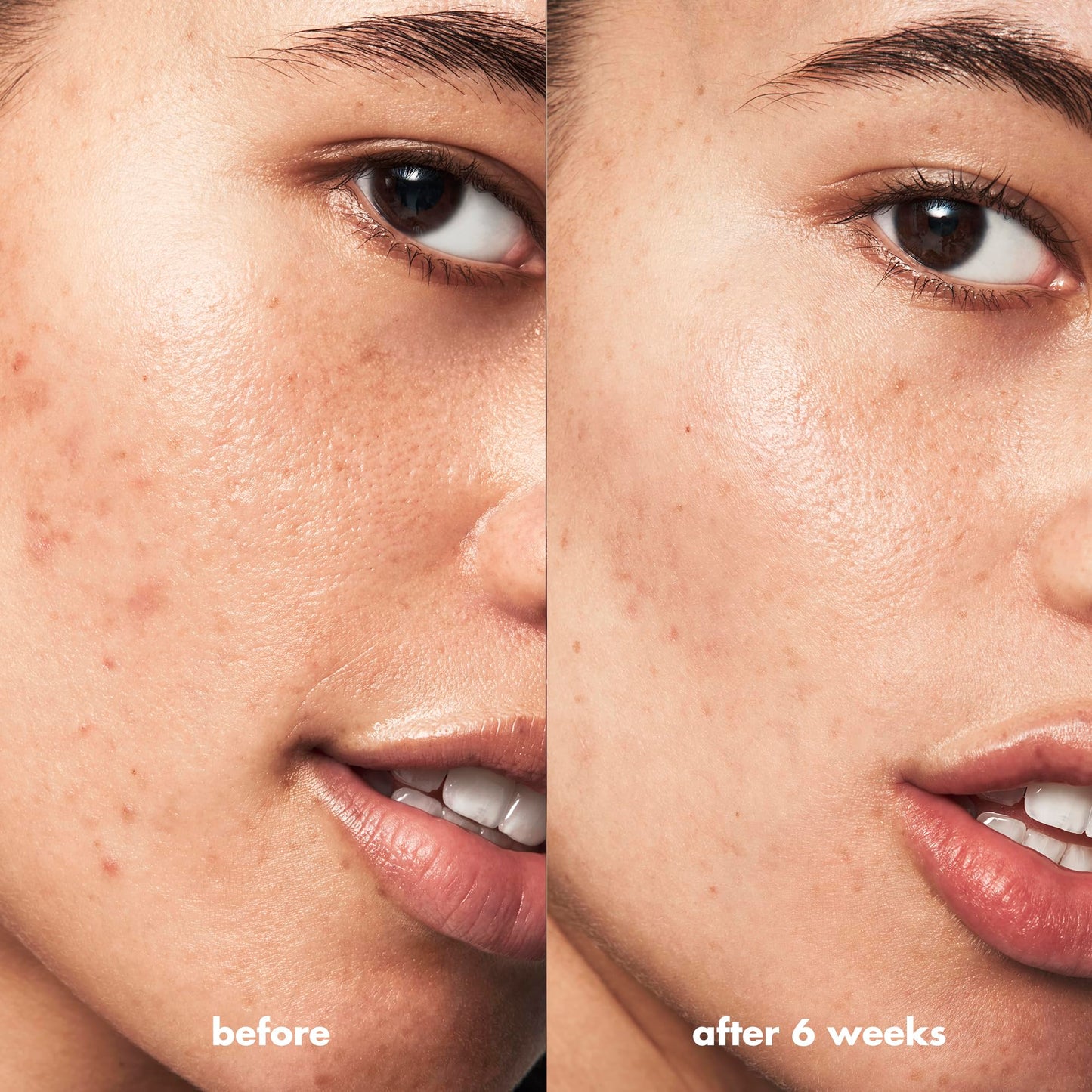 e.l.f. SKIN Blemish Breakthrough Blemish Fighting Spot Gel, Roll-on Blemish Spot Gel For Targeting & Treating Blemishes, Infused With Salicylic Acid