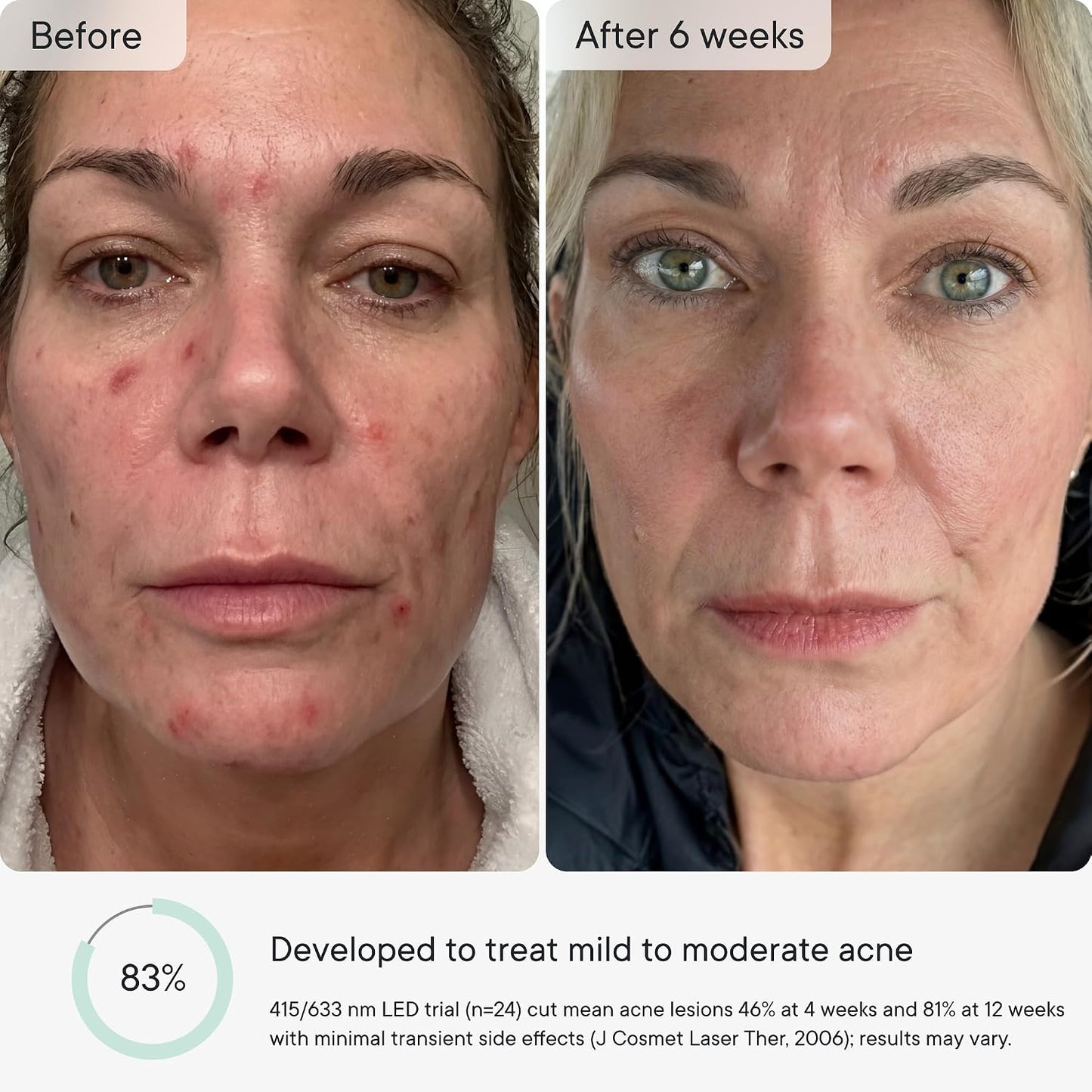 LED Light Therapy Mask for Face - FDA Cleared Wrinkle & Acne Treatment | 3 Modes, 5 Areas, 5 Lights