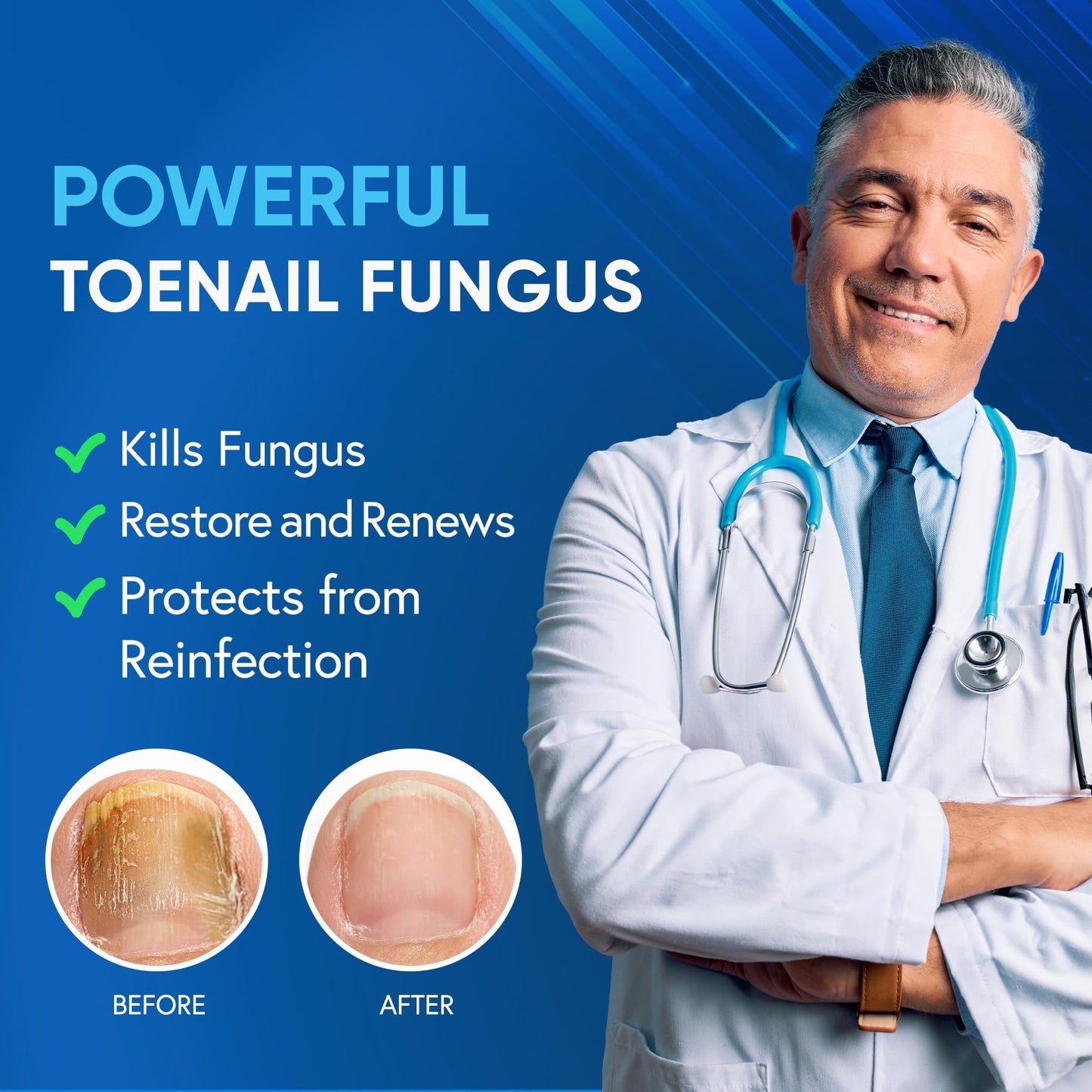 Toenail Fungus Treatment Extra Strength with 25% Undecylenic Acid & Tea Tree Oil - Antifungal Nail Treatment for Damaged Nails and Thick Toenails (2 Fl Oz)