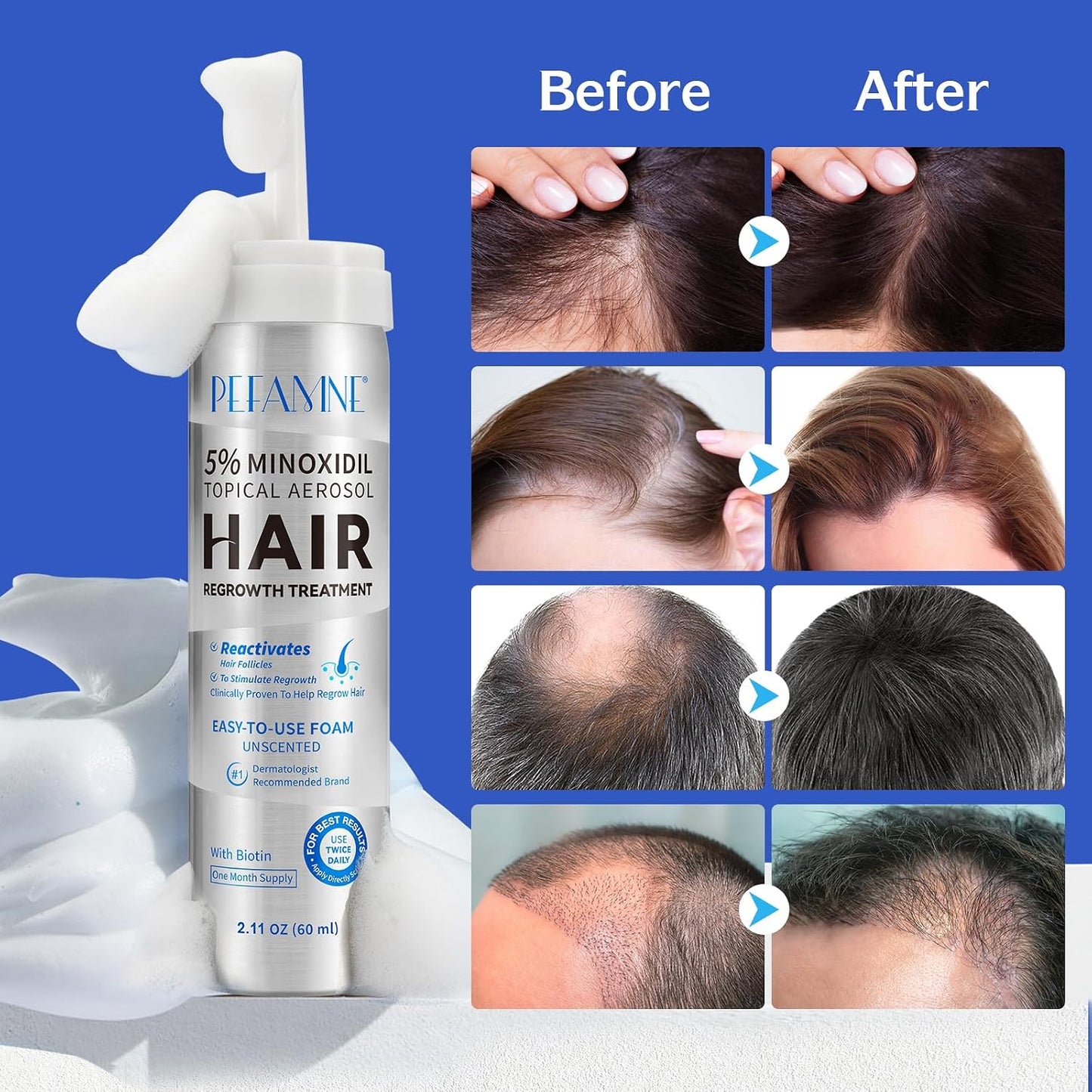 Minoxidil Hair Growth Foam - Effective Treatment for Hair Thinning & Scalp Loss | For Men & Women