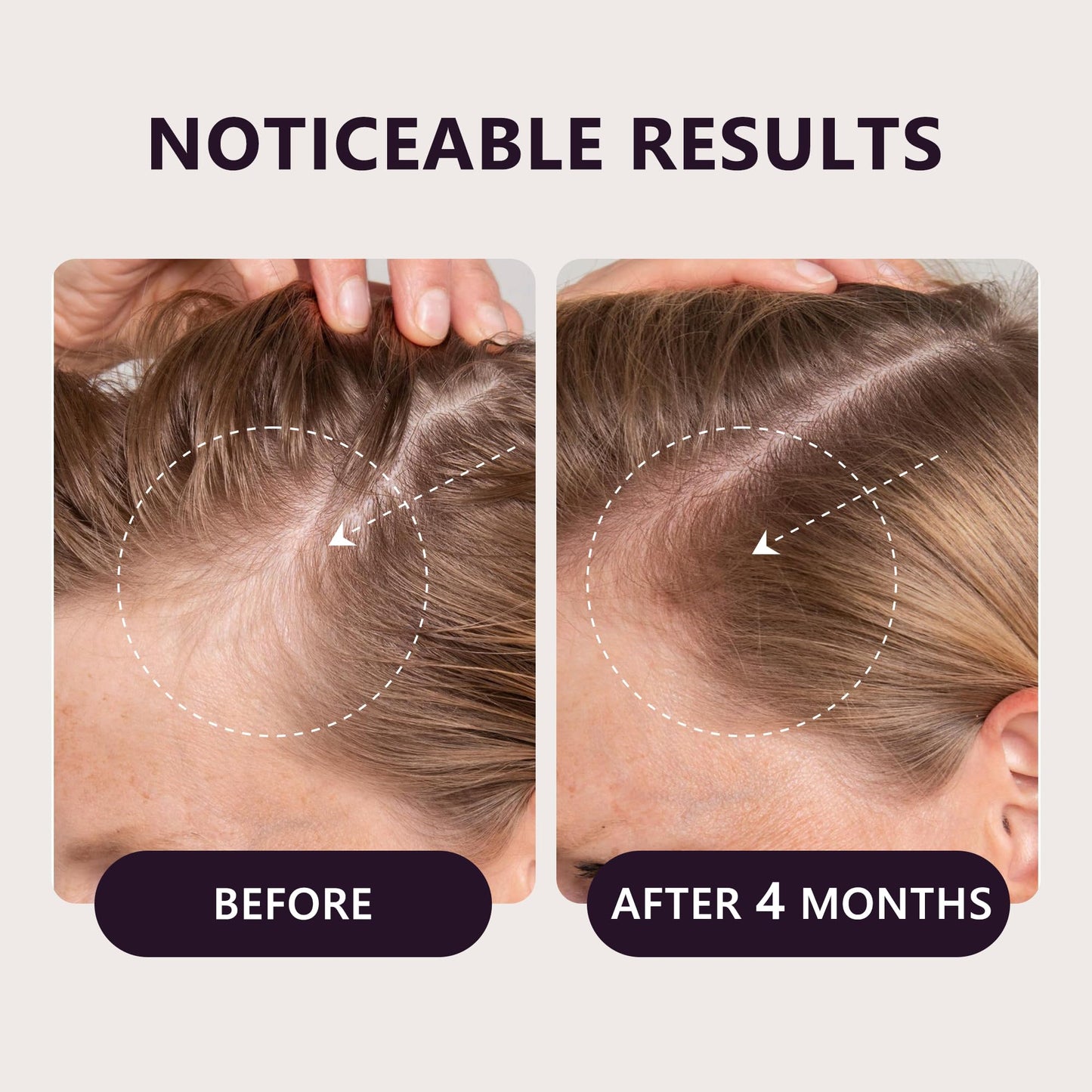 5% Minoxidil Hair Growth Serum for Women: Extra Strength Hair Loss Treatment with Biotin for Thinning Hair - Regrowth Topical Solution (2 Fl Oz (Pack of 1))