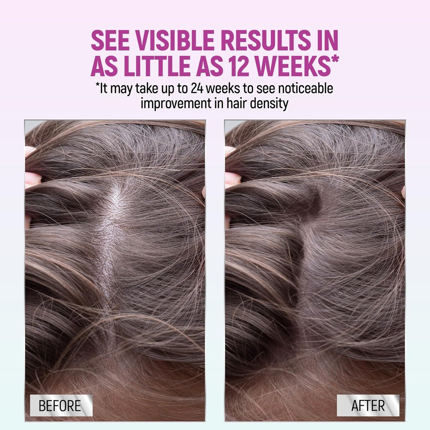 Minoxidil for Women - 5% Hair Regrowth Foam | Clinically Proven, 2.11 Oz (2-Month Supply)