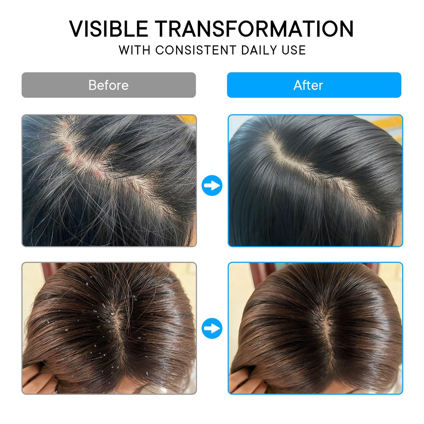 ProBliva Psoriasis Scalp Care System
