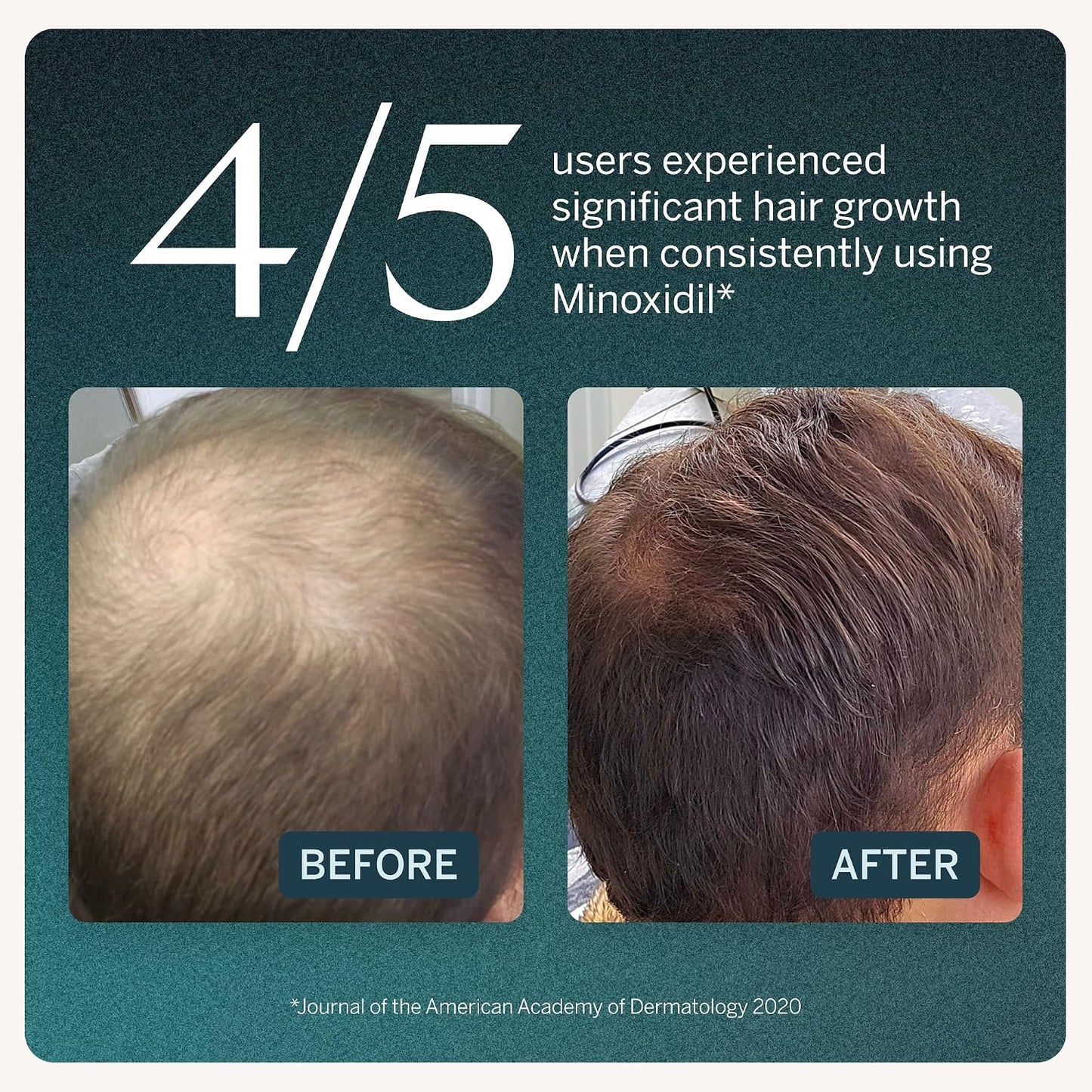Minoxidil Hair Growth Serum for Men - 5% Solution, Unscented Daily Use | 3 Bottles, 60 mL Each