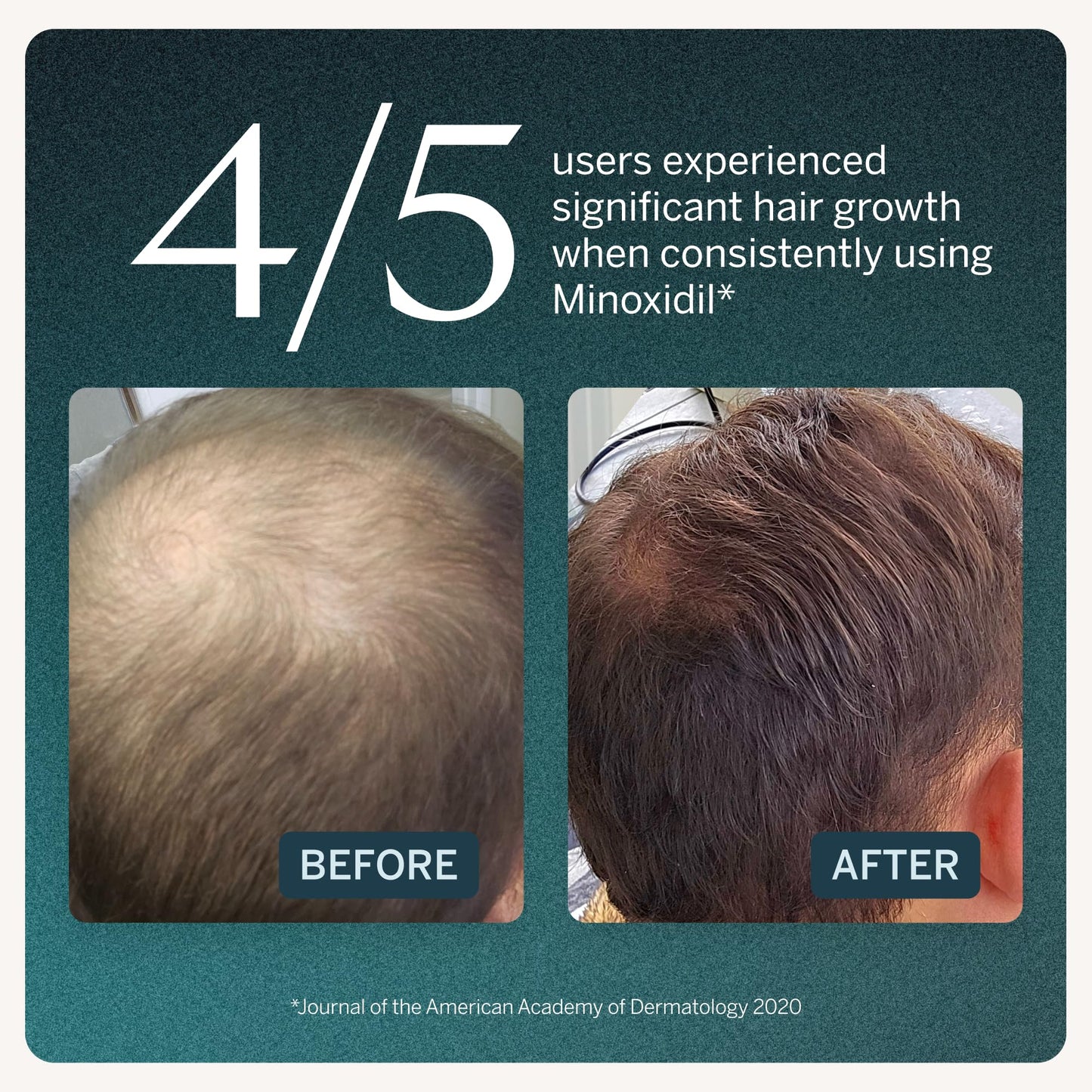 Happy Head Minoxidil Topical Hair Serum 5% Solution for Men, Hair Growth Support Formula, Unscented Scalp Application for Daily Use at Home, 3 Month Supply with 3 Bottles 60 mL Each