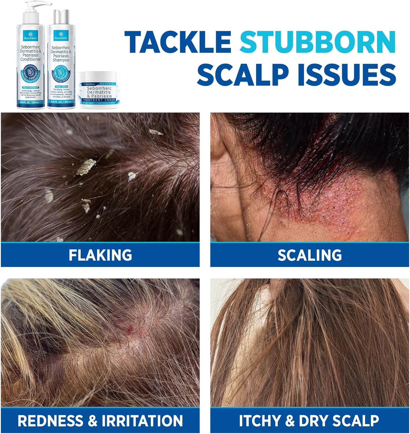 Seborrheic Dermatitis & Psoriasis Treatment Set - Scalp Therapy Cream, Shampoo & Conditioner for Itching, Flaking Relief | 3-Piece System