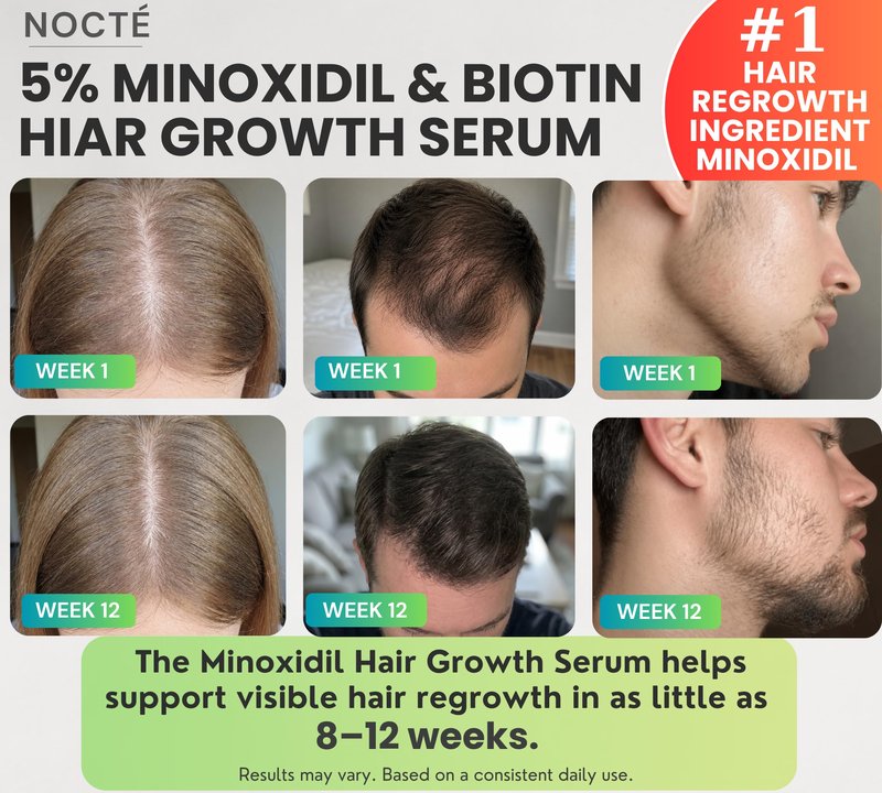 Nocte 5% Minoxidil Hair Regrowth Serum Spray for Men & Women – Biotin, Caffeine & Rosemary Botanical Complex, Extra Strength Hair Loss Treatment for Thicker, Fuller, Longer Hair – 60ML