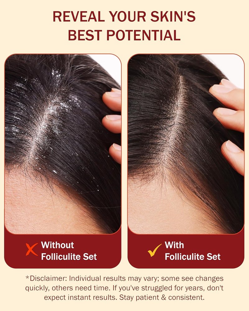 Folliculitis Treatment Serum | Leave-On Scalp Care with 3% BHA, Salicylic Acid & Tea Tree Oil - 2 fl oz