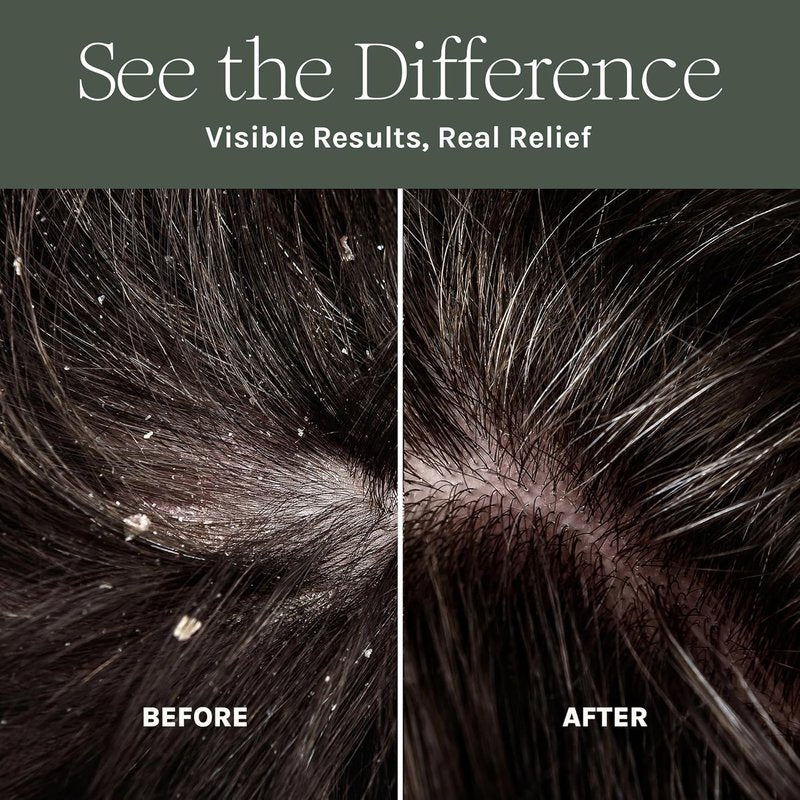 Purist Dandruff Spray - Leave-In Itchy Scalp Treatment | Hydrating, Lightweight Moisturizer for Dryness & Flaky Skin